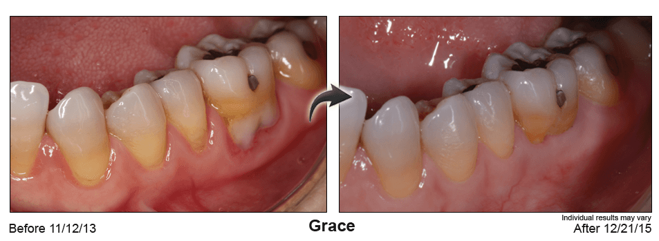 Before and after Pinhole Gum Rejuvenation® treatment at Amber Dental
