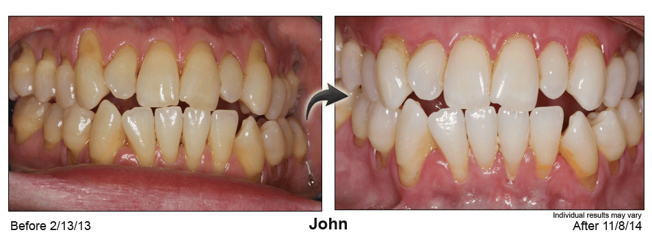 Before and after Pinhole Gum Rejuvenation® treatment at Amber Dental