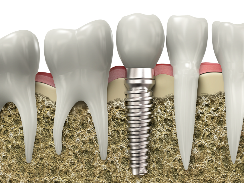 A rendering showing the three parts of a dental implant