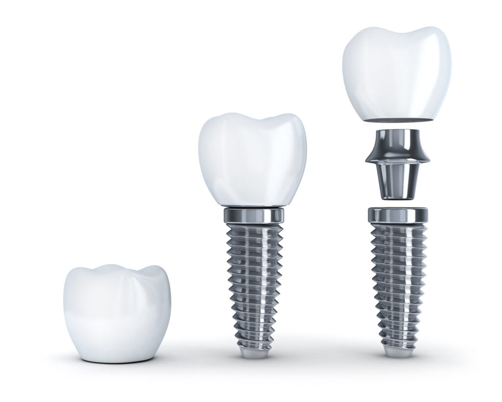A rendering showing the three parts of a denta implant