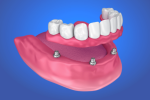 A rendering showing All-On-Four implant dentures