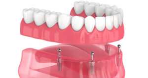 All-on-X dental implants are a modern solution to missing teeth.